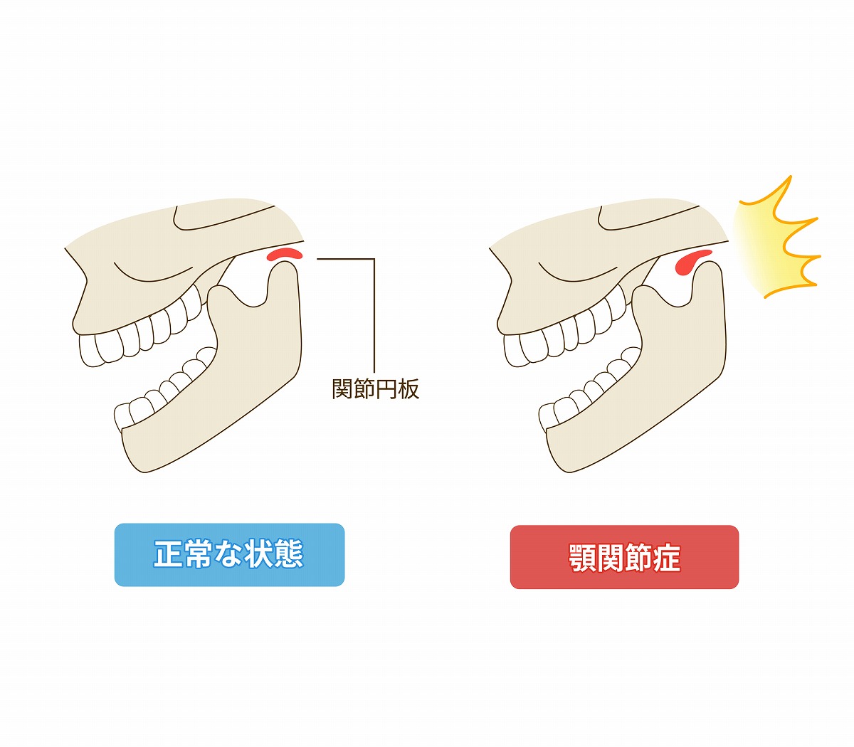 顎関節症