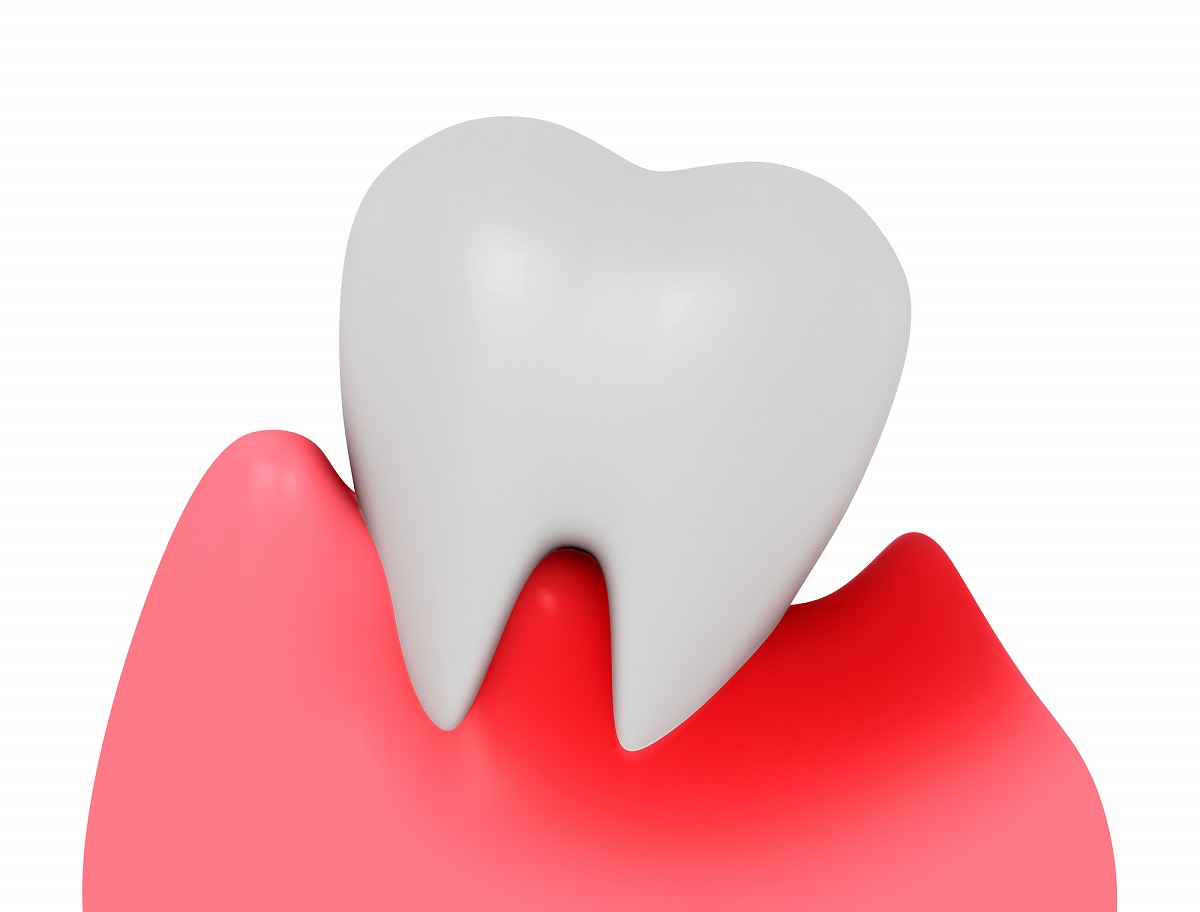 大人の約8割がかかっている歯周病