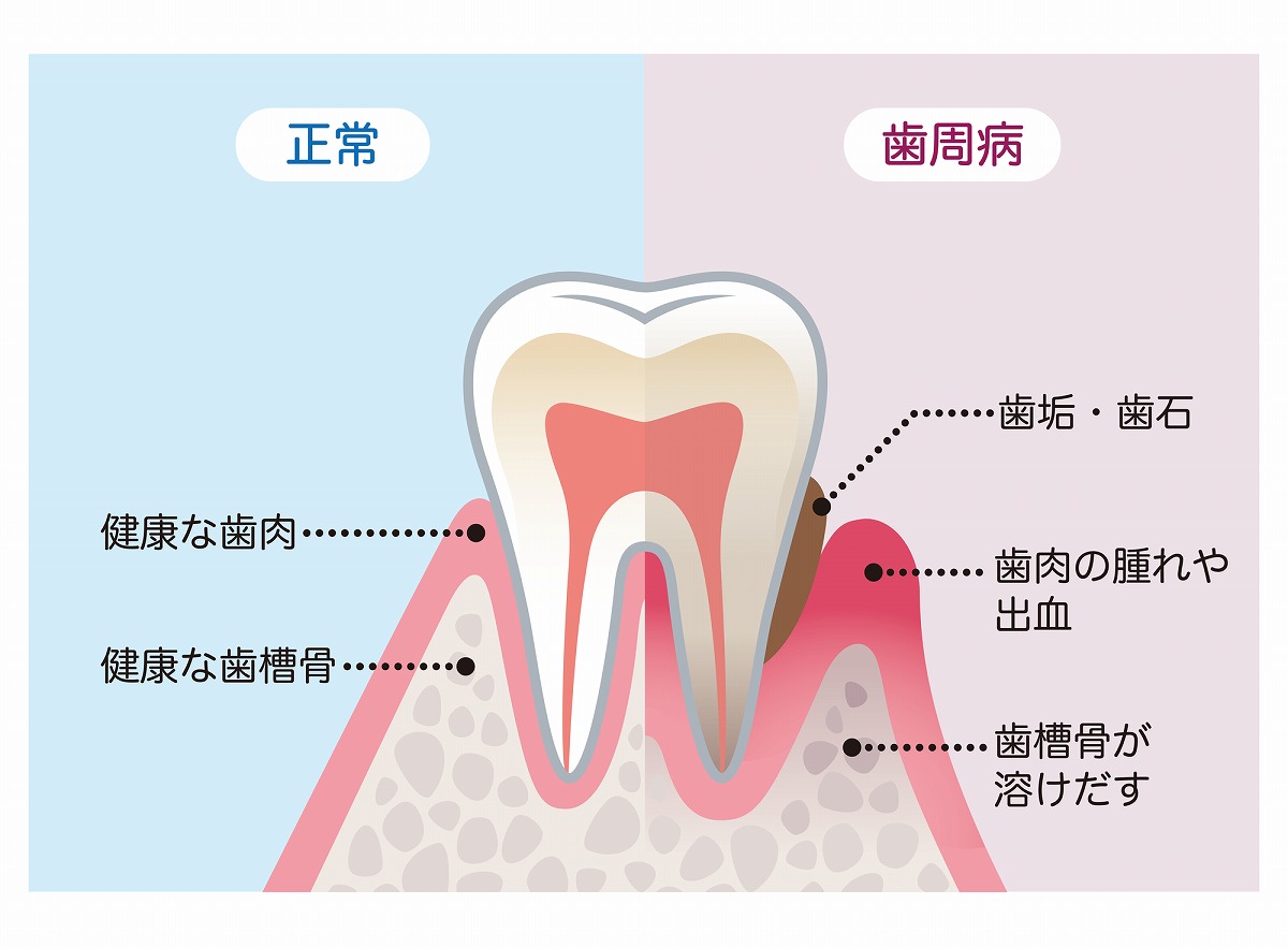 歯周病の原因