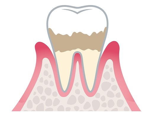 歯周炎(軽度)