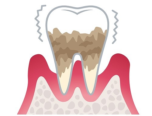 歯周炎(重度)