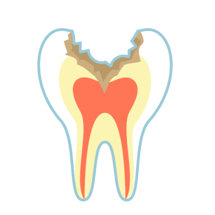 C3（神経まで進行したむし歯）