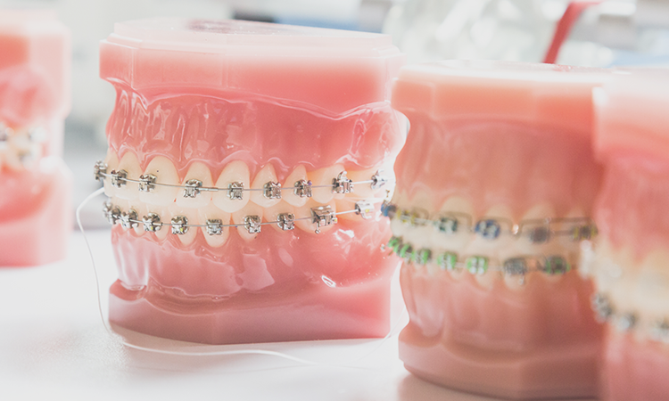 歯並びとかみ合わせを改善する矯正治療